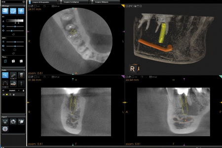 Tomografia komputerowa pojedynczych zębów